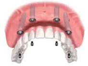 安心・安全の歯科用CT